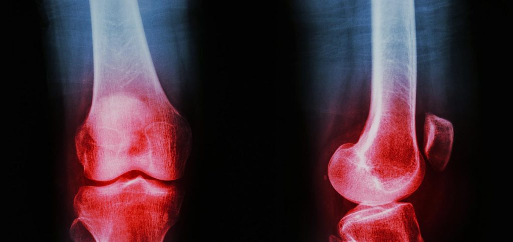 Osteoarthritis - Lifestyle Changes that Ease the Pain